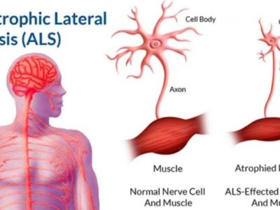 Amyotrophic Lateral Sclerosis (ALS)